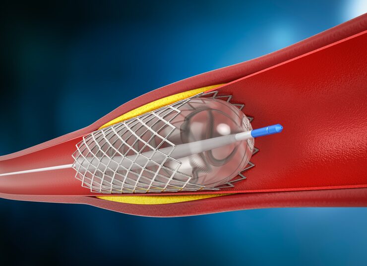 Carotid Angioplasty for improved blood flow